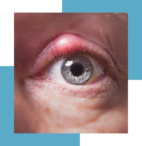acos blepharitis dry eye